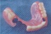 protesis dentales flexibles, 