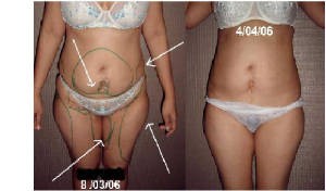 cynthia Avisos gratis en Chile en Santiago |  masajes reductivos,tratamientos reductores garantizados,masajes modeladores, masajes reductivos 2228567