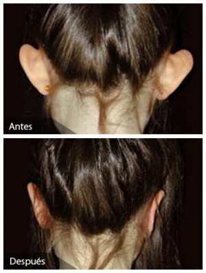 horacio valdivia Avisos gratis en Chile en Vi&ntilde;a del Mar |  Otoplastia en vi&ntilde;a (cirugia de orejas), cirugia de orejas