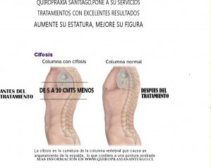 carlos Avisos gratis en Chile en Santiago |  aumente su estatura, quiropraxia en santiago
