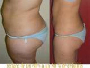 mauricio Avisos gratis en Chile en Las Condes |  Baja talla en 12 sesiones y tan solo a $60000, Comienza el 2010 con varias tallas menos